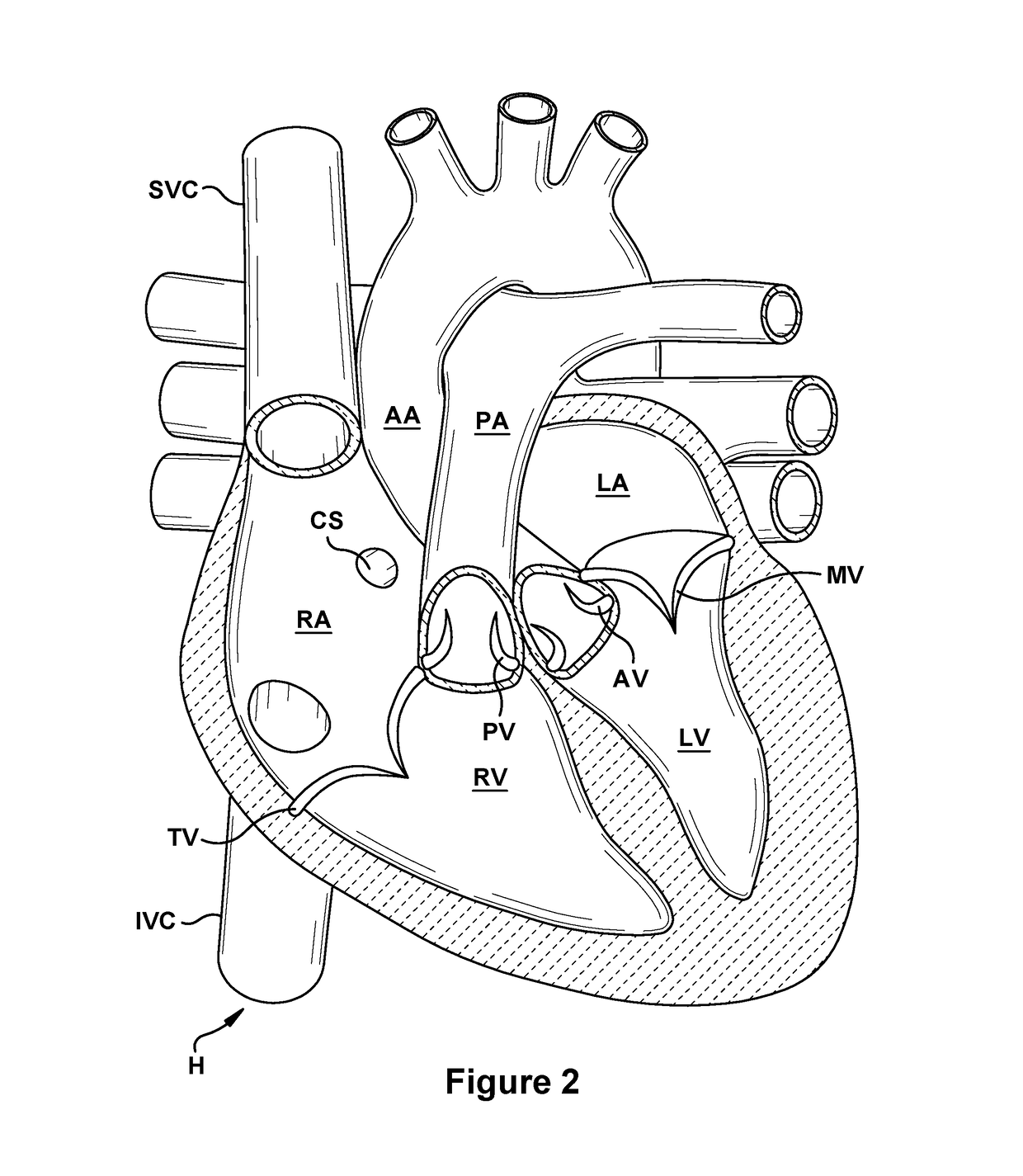 Native valve repair devices and procedures