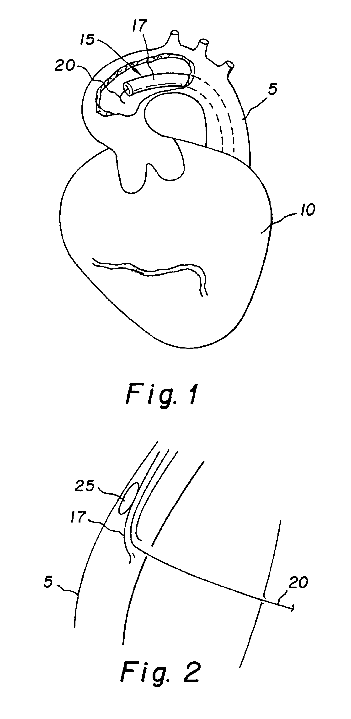 Method and apparatus for performing an anastamosis