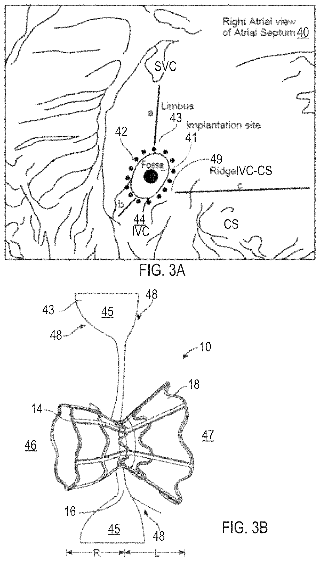 Asymmetric shunt for redistributing atrial blood volume