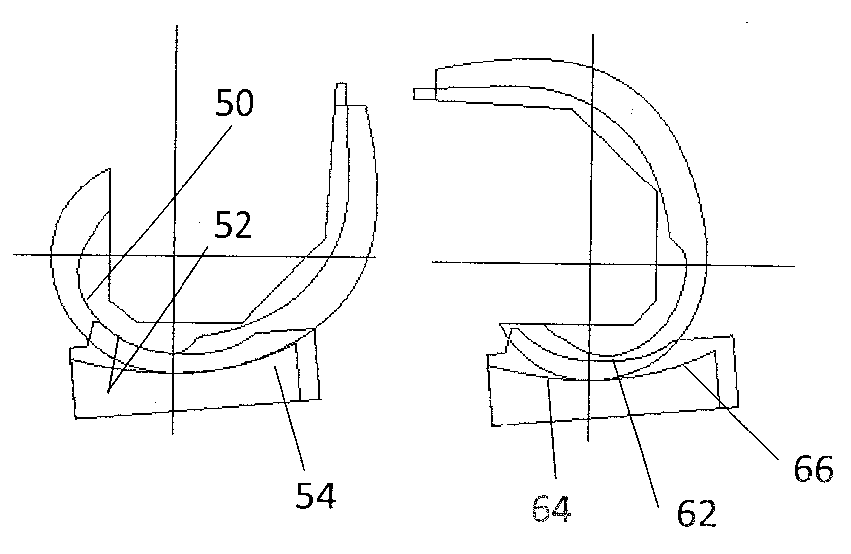 Total knee replacement substituting function of anterior cruciate ligament