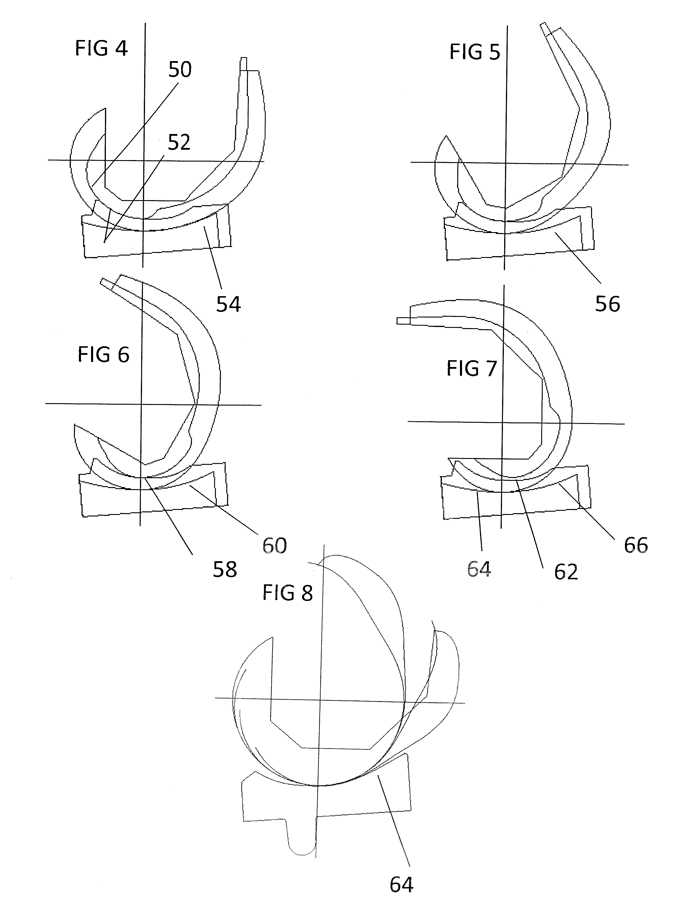 Total knee replacement substituting function of anterior cruciate ligament