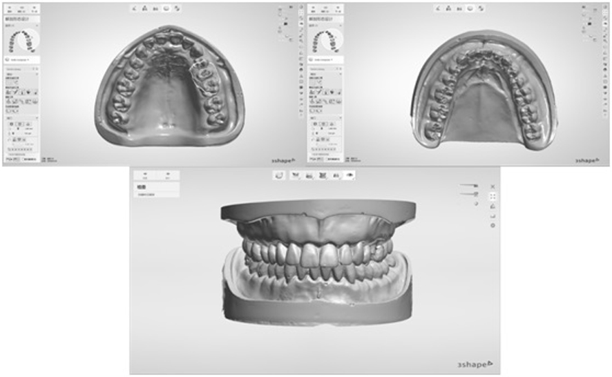 A Novel Digital Post-core Impression Acquisition and Model Establishment Method Without Plasterization