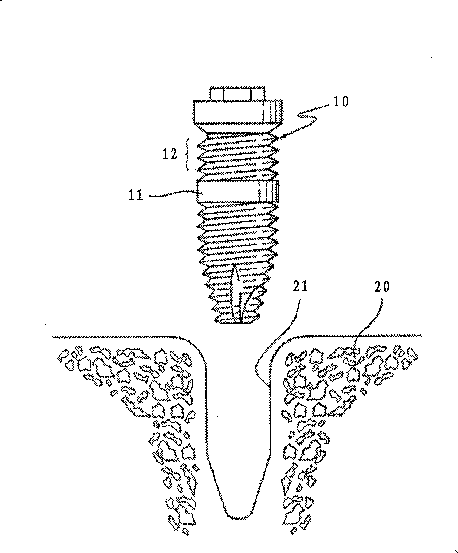 Synostosis artificial tooth