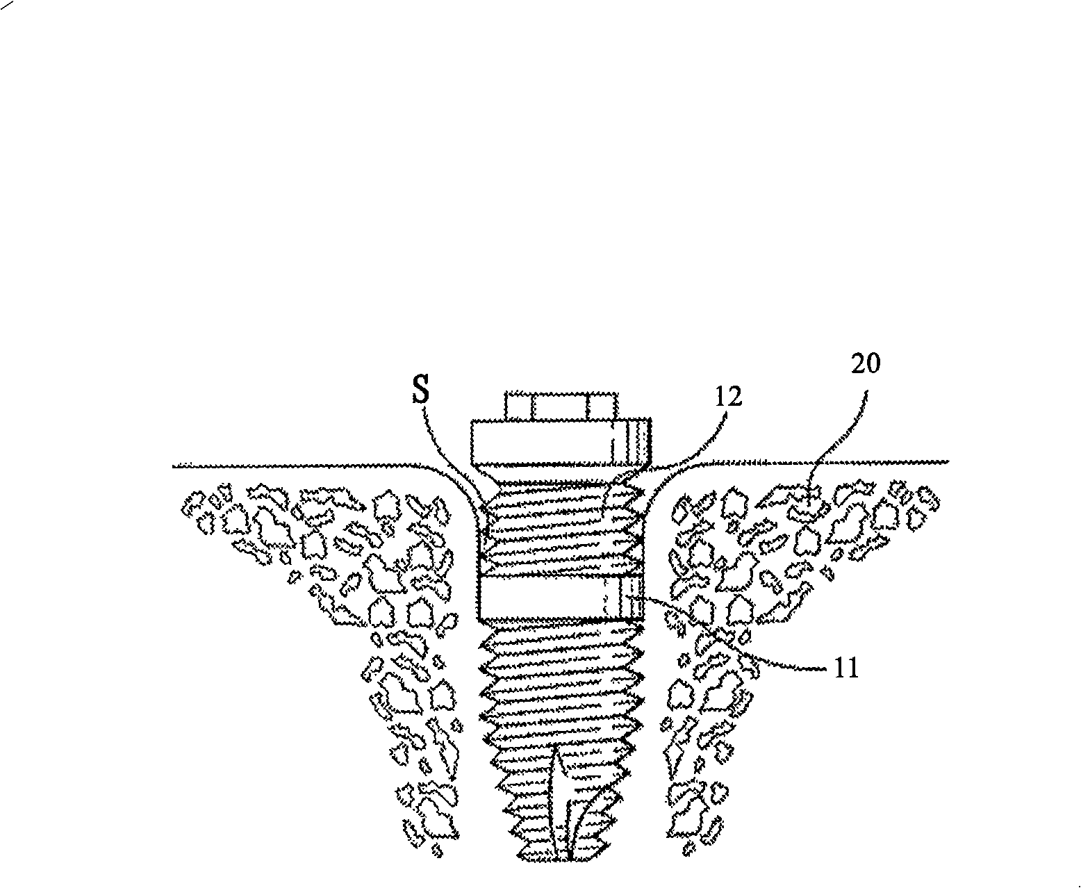 Synostosis artificial tooth