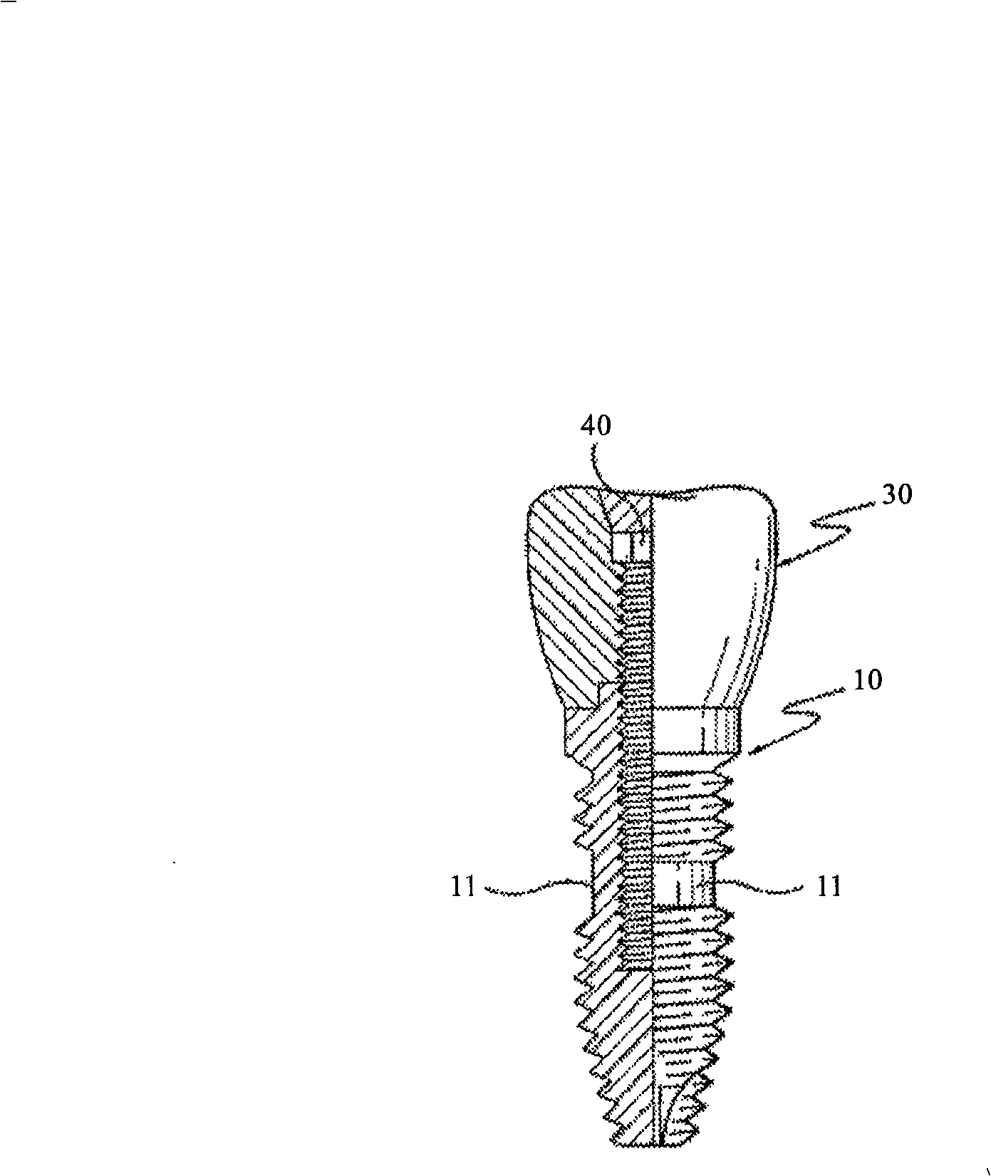 Synostosis artificial tooth