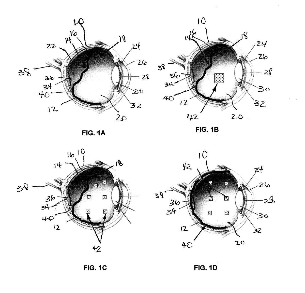 Methods and devices for treating a retinal detachment