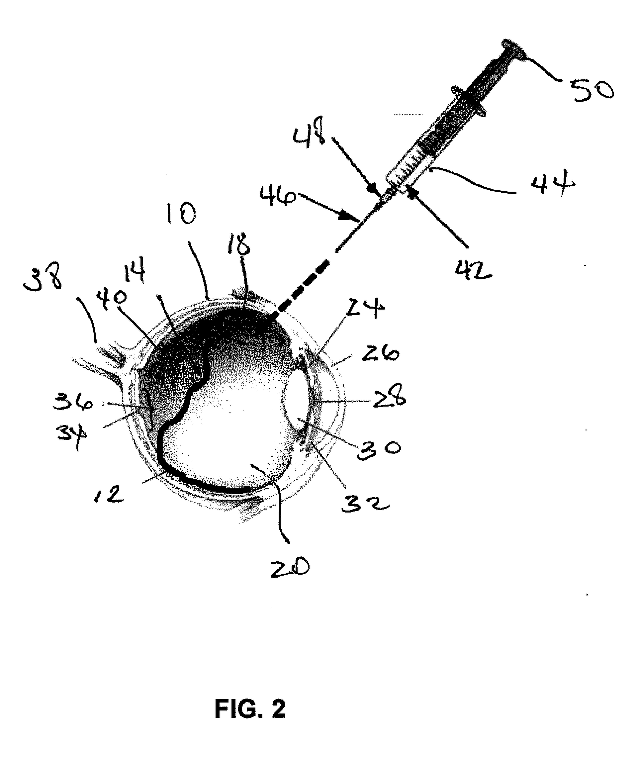 Methods and devices for treating a retinal detachment