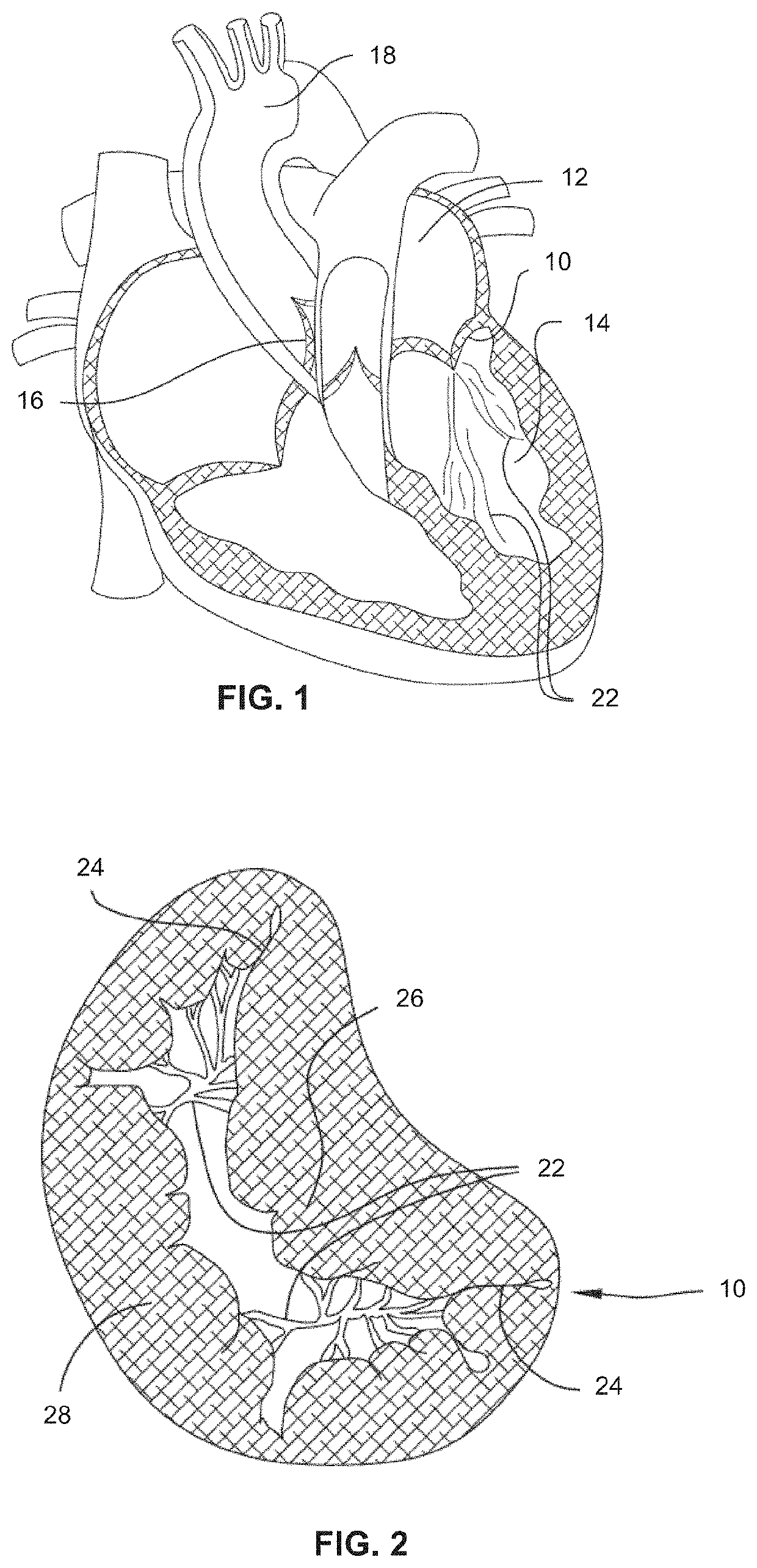 Systems, devices, and methods for treating heart valves