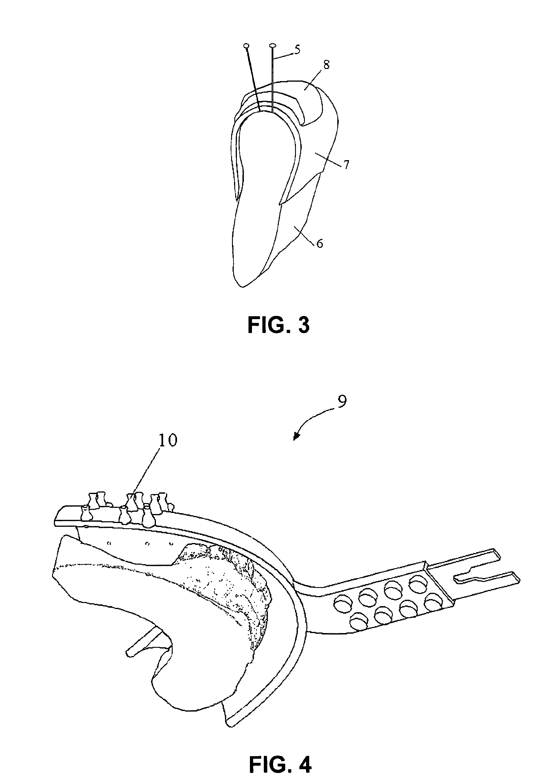 Method for creating a personalized digital planning file for simulation of dental implant placement