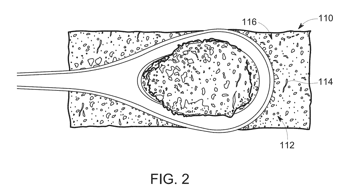 Compressed decalcified trabecular bone grafts and tooth socket repair