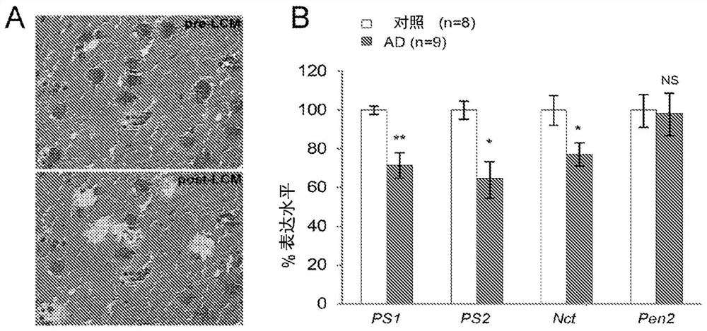 Gene therapy for alzheimer's disease