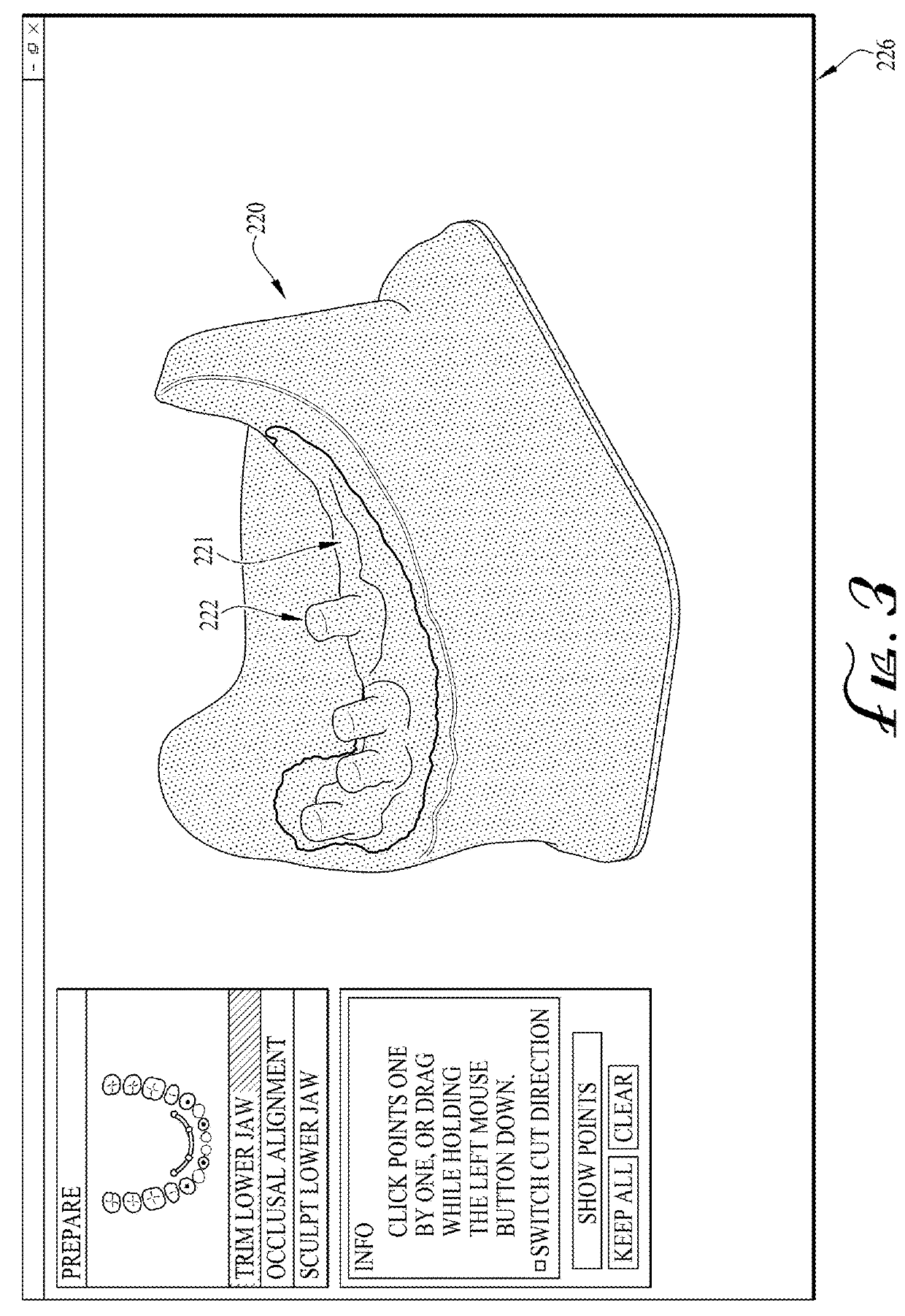 Digital design and manufacturing process for denture abutment luting bar