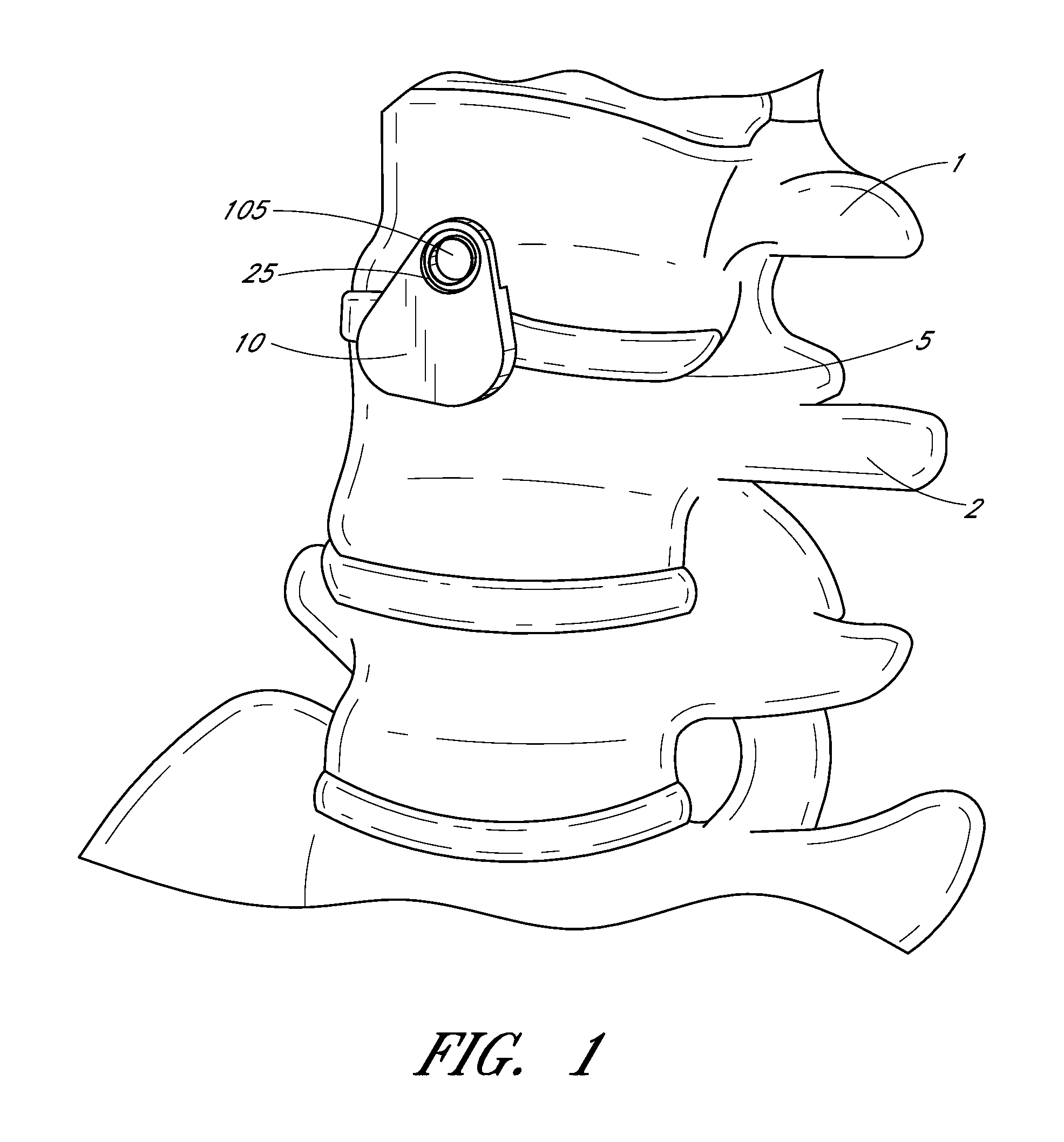 Buttress plate system