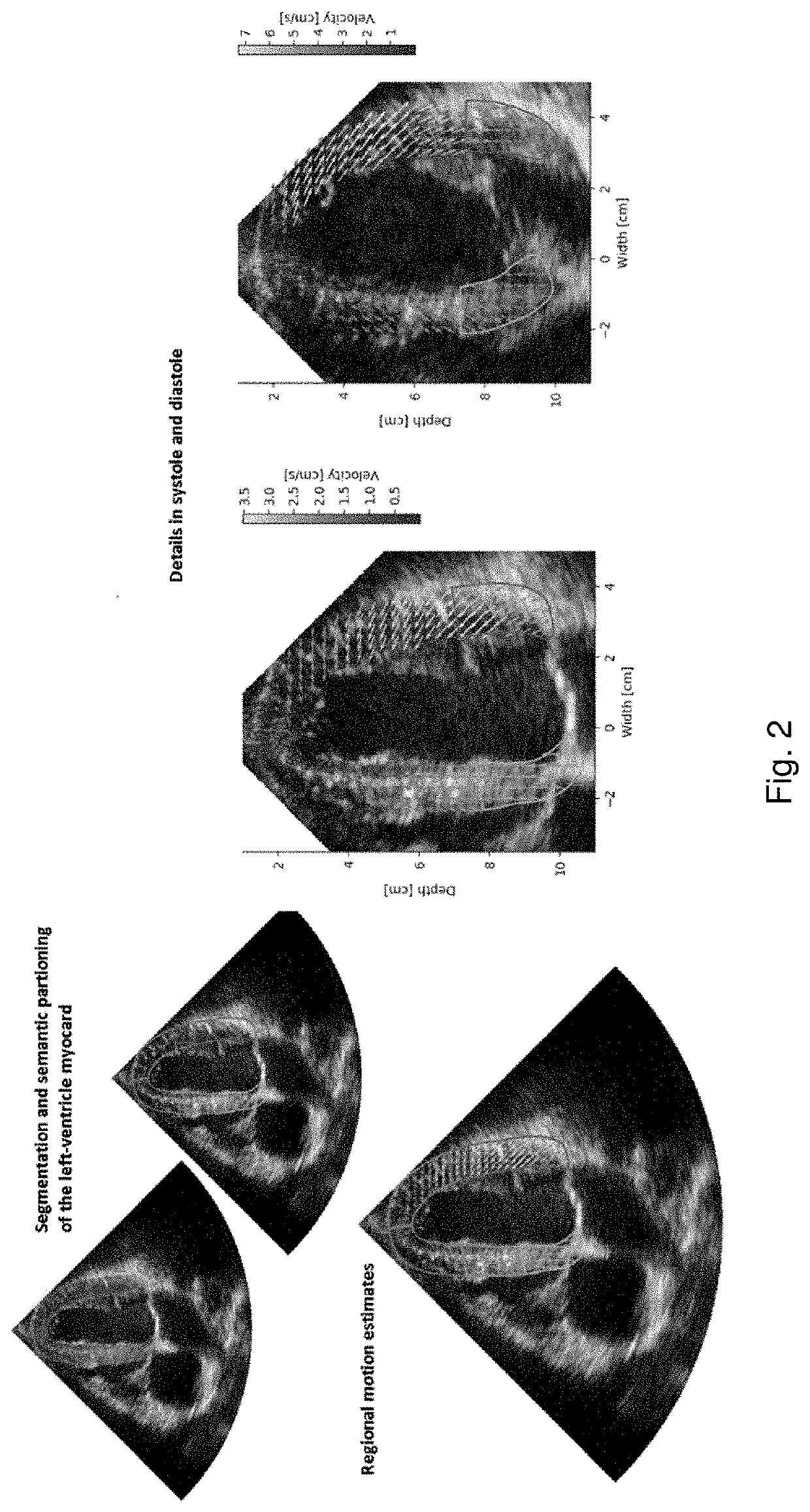 Functional measurements in echocardiography