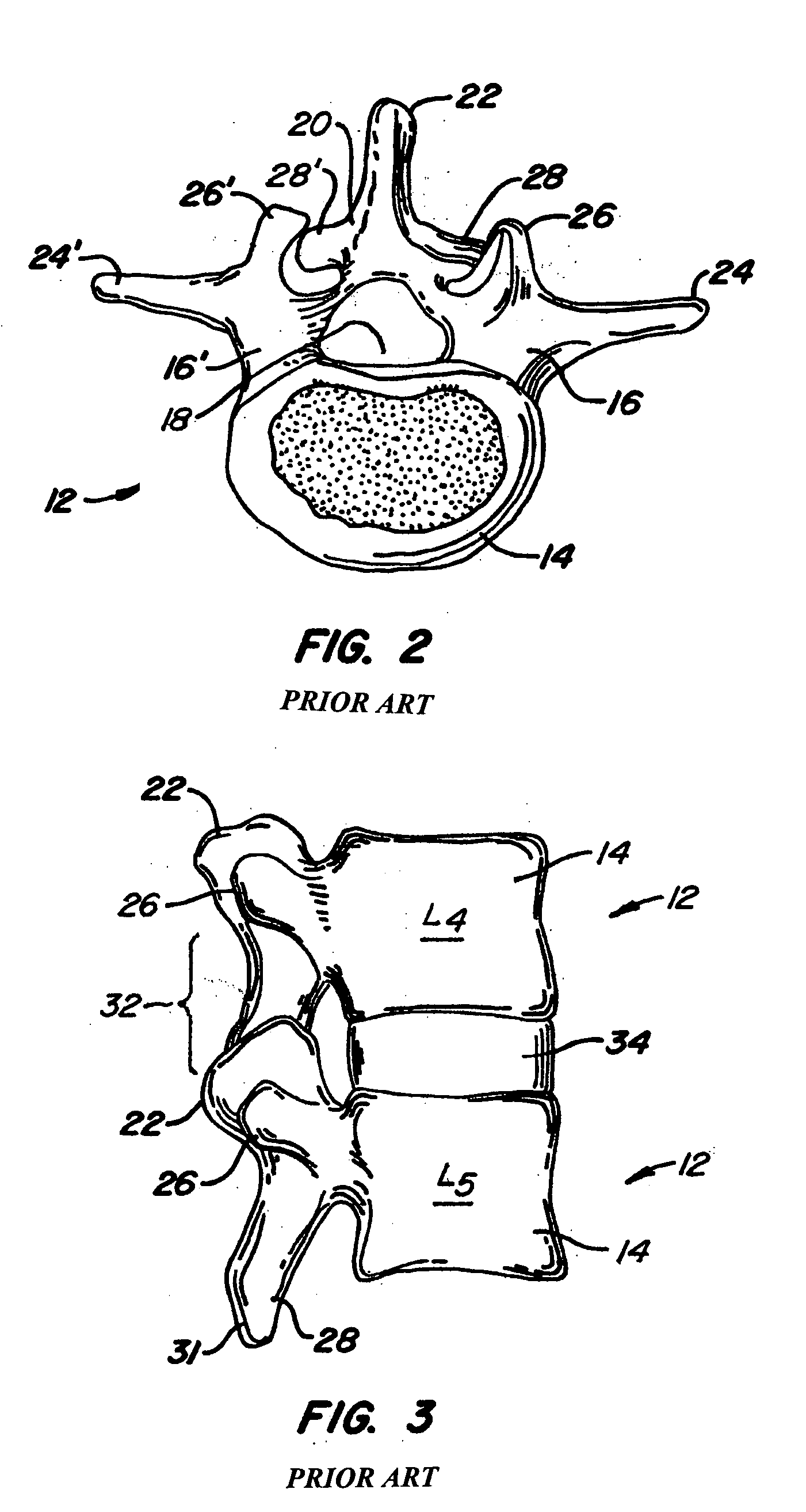 Adjacent level facet arthroplasty devices, spine stabilization systems, and methods