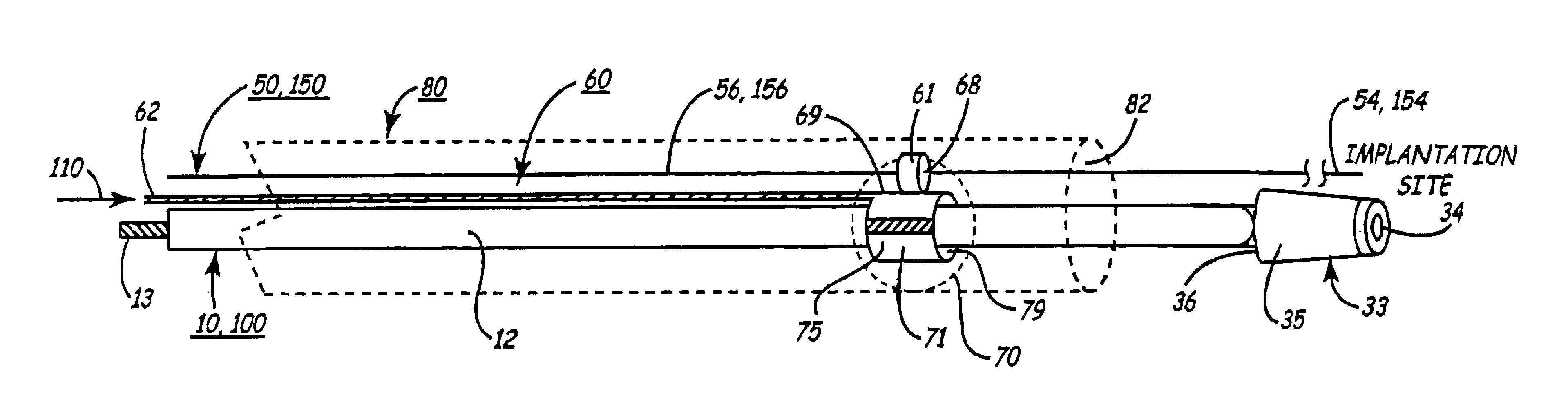 Arrangement for implanting an endocardial cardiac lead