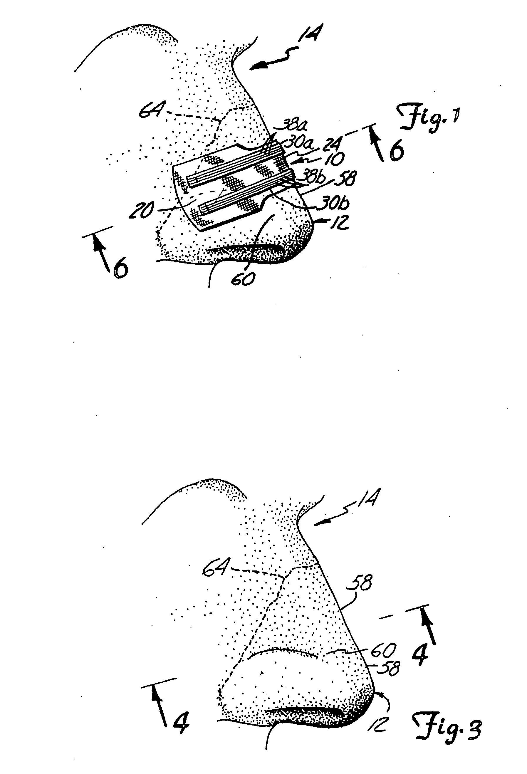 Nasal Therapeutic System