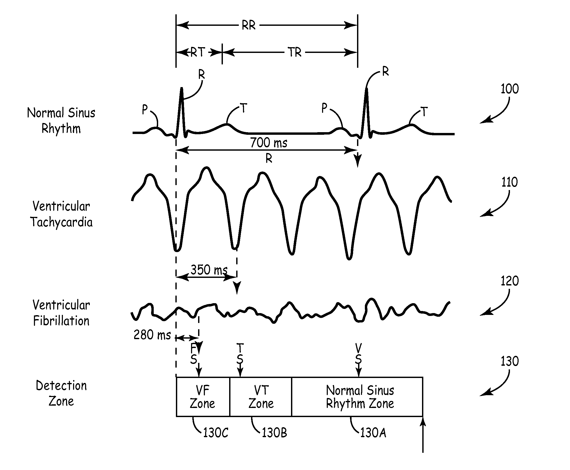 Implantable medical device with real time T-wave oversensing detection