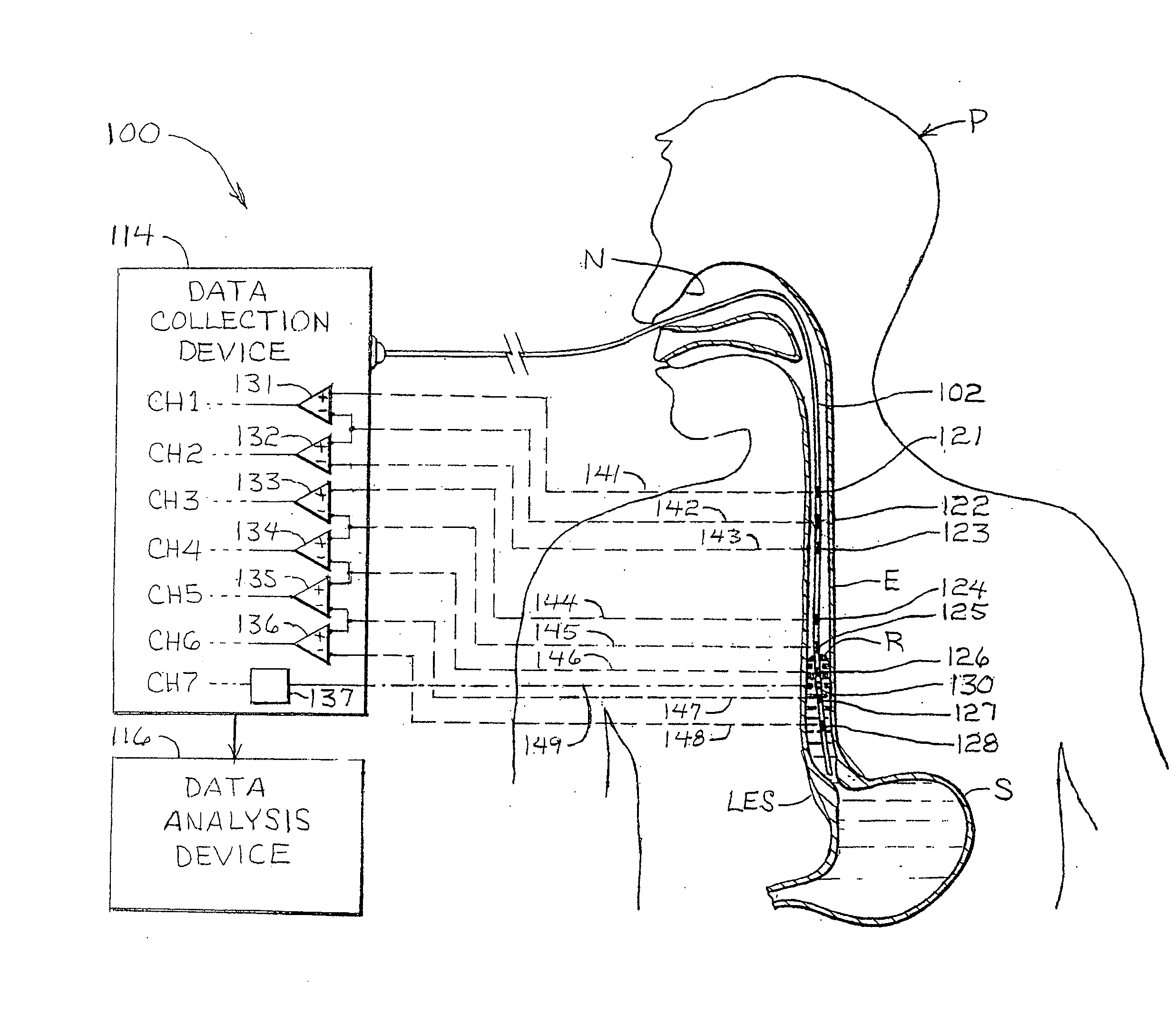 Esophageal waveform analysis for detection and quantification of reflux episodes