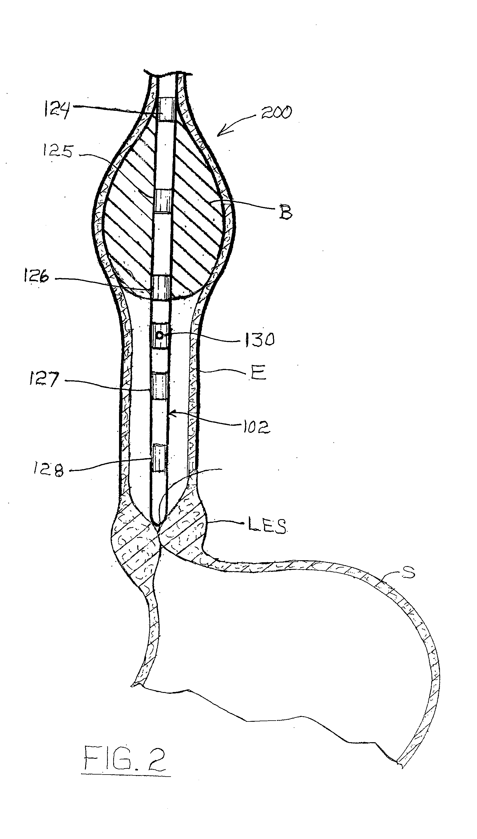 Esophageal waveform analysis for detection and quantification of reflux episodes