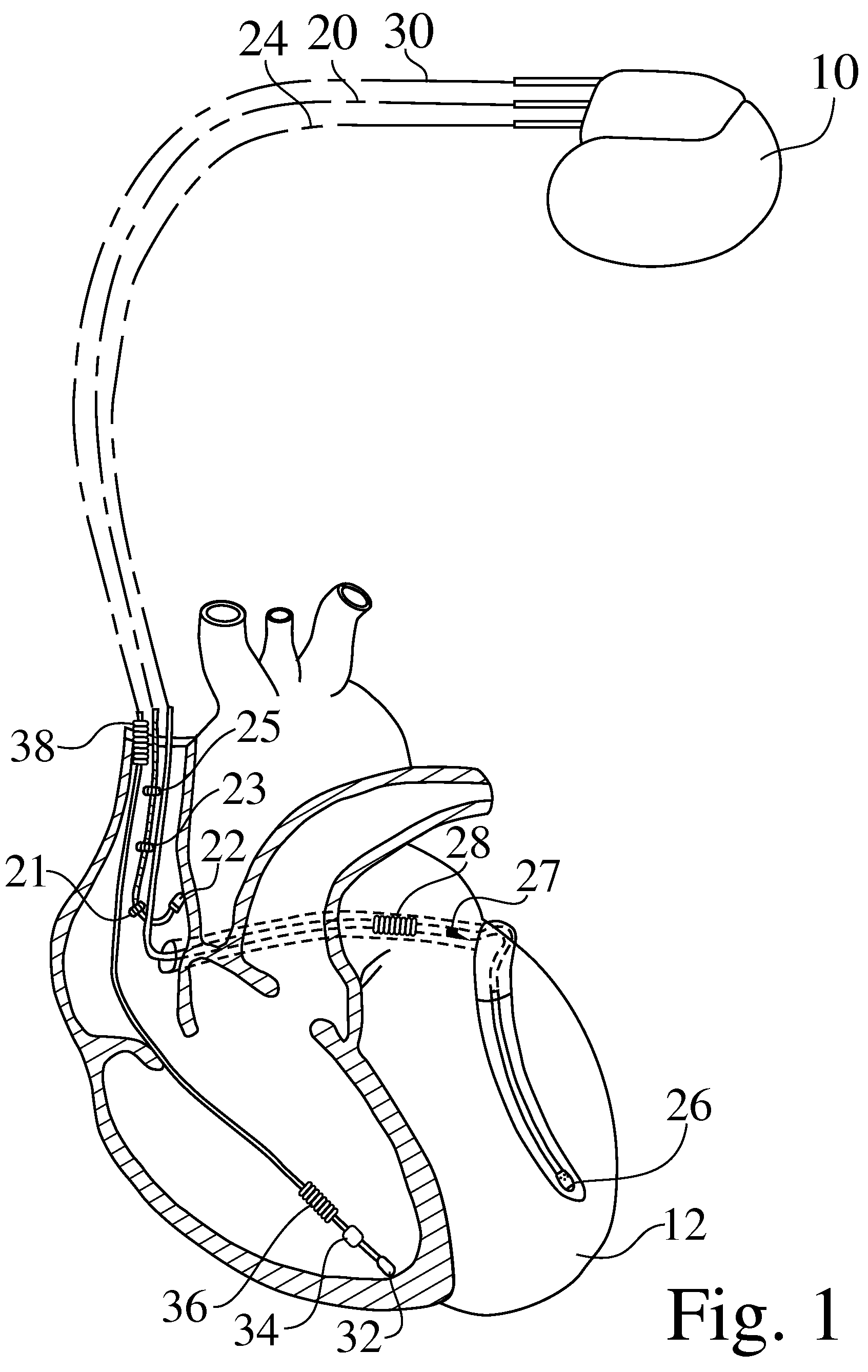 Guided atrial anti-tachycardia pacing for implanted cardiac stimulation