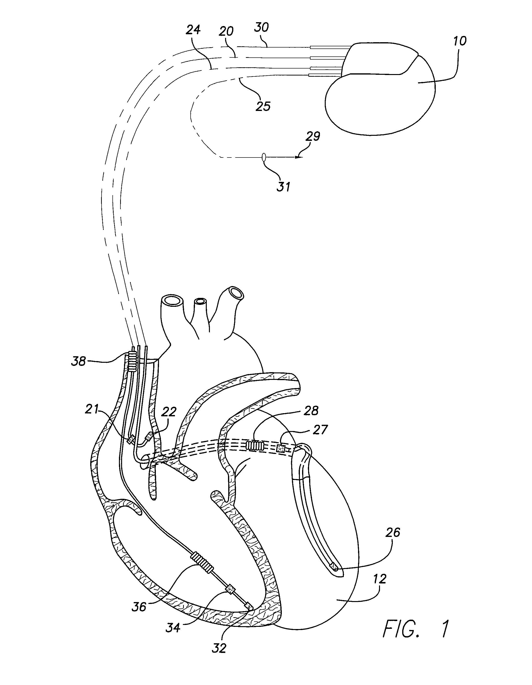 Implantable medical device with sleep apnea detection control and method