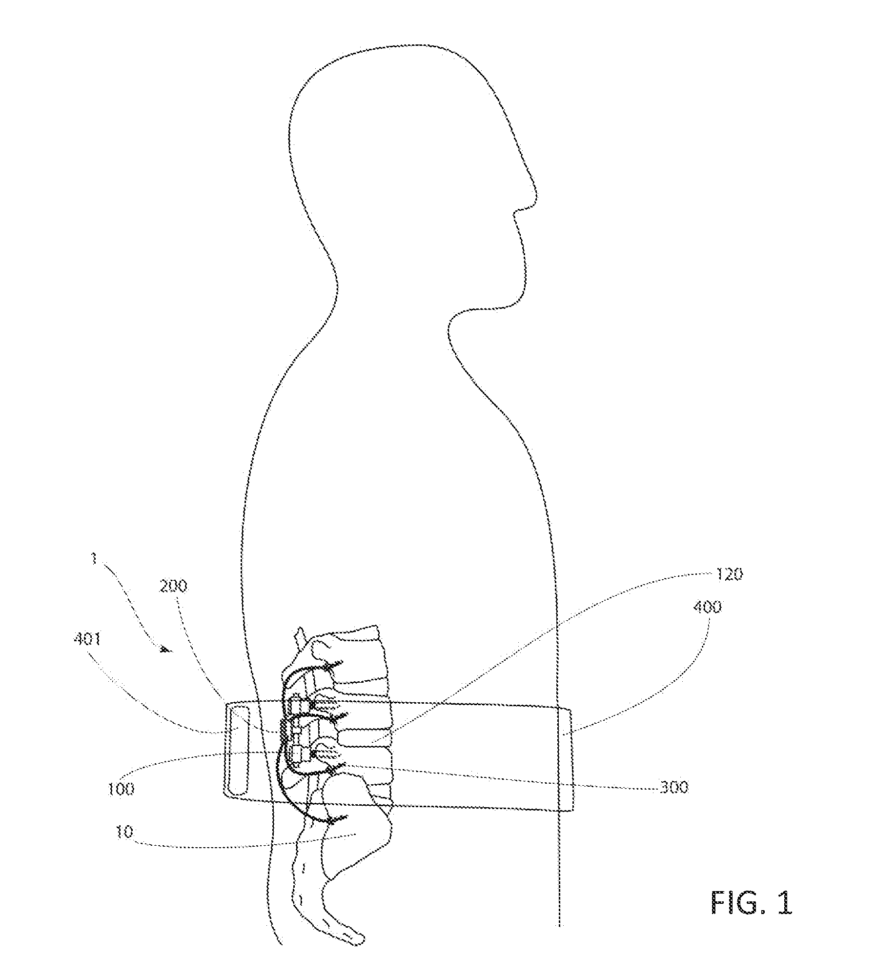 Method and Apparatus for an Implantable Inertial-Based Sensing System for Real-Time, In Vivo Detection of Spinal Pseudarthrosis and Adjacent Segment Motion