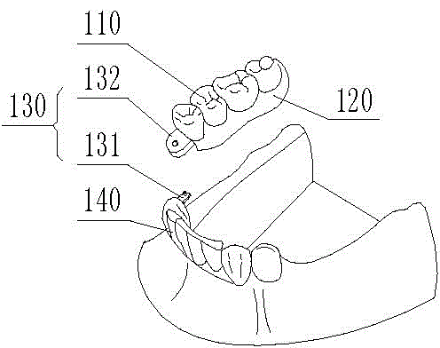 Broken-stress attachment denture