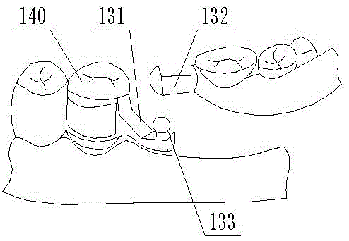 Broken-stress attachment denture