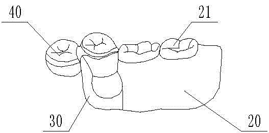 Broken-stress attachment denture