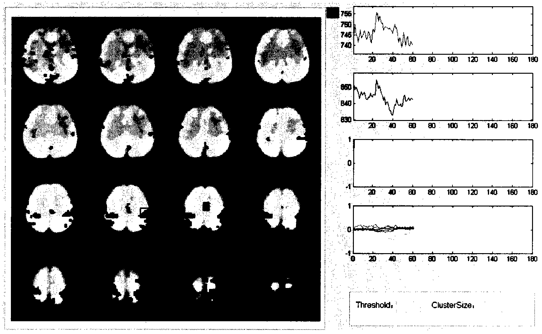 Real-time functional magnetic resonance data processing system based on brain functional network component detection