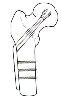 Memory pressurization hip lag screw system