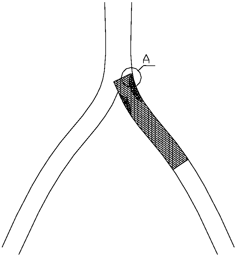 Stent for near bifurcation part lesion