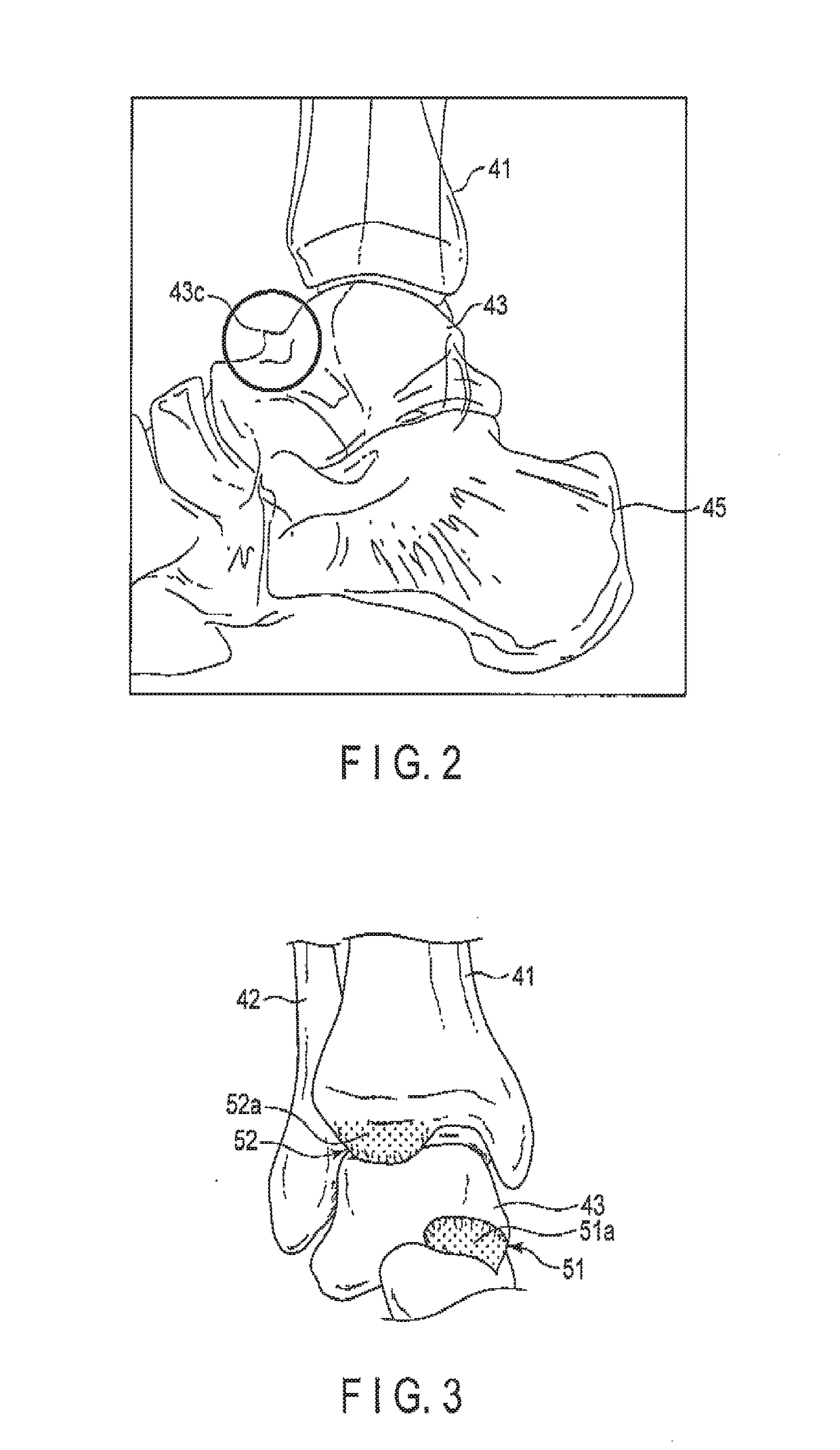 Arthroscopic surgery method for ankle impingement