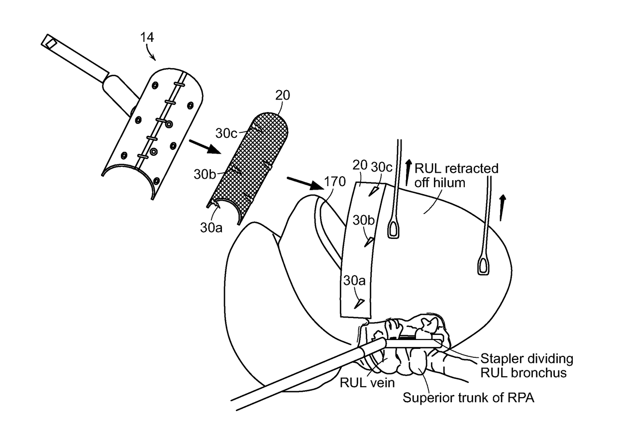 Delivery system for positioning and affixing surgical mesh or surgical buttress covering a surgical margin