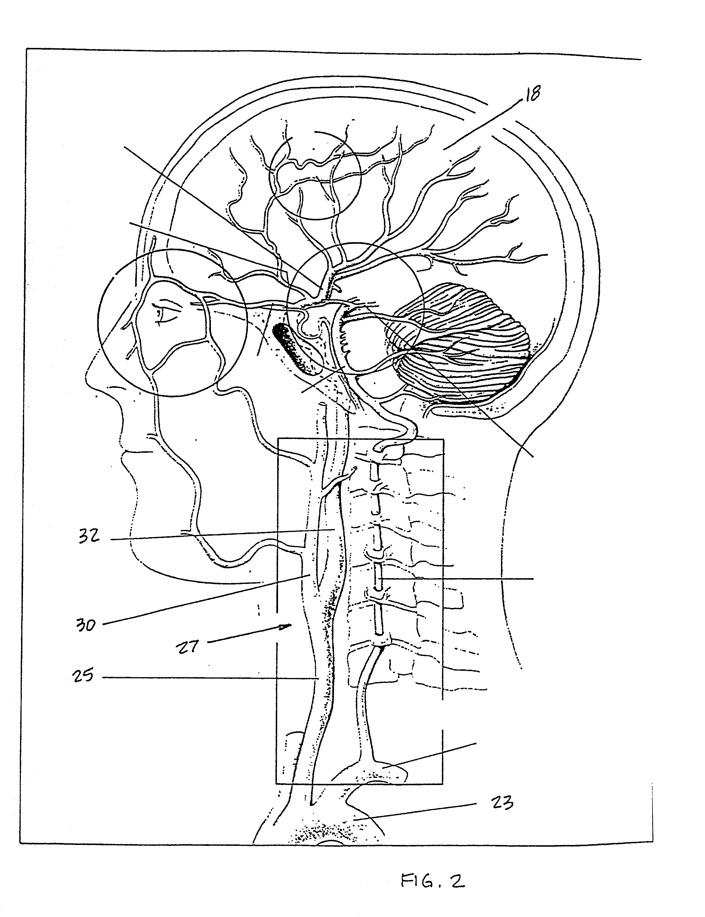 Indwelling heat exchange catheter and method of using same