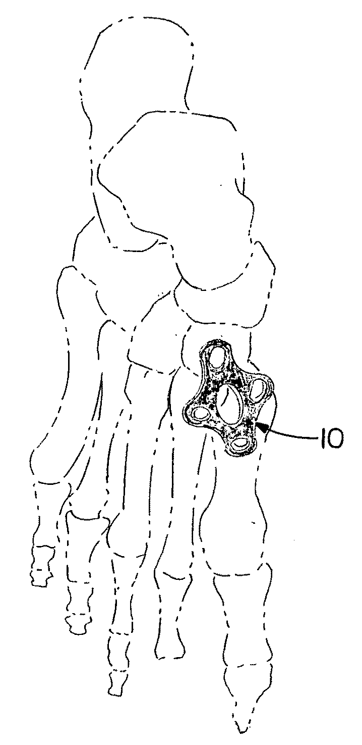 Orthopedic plate for use in the midfoot