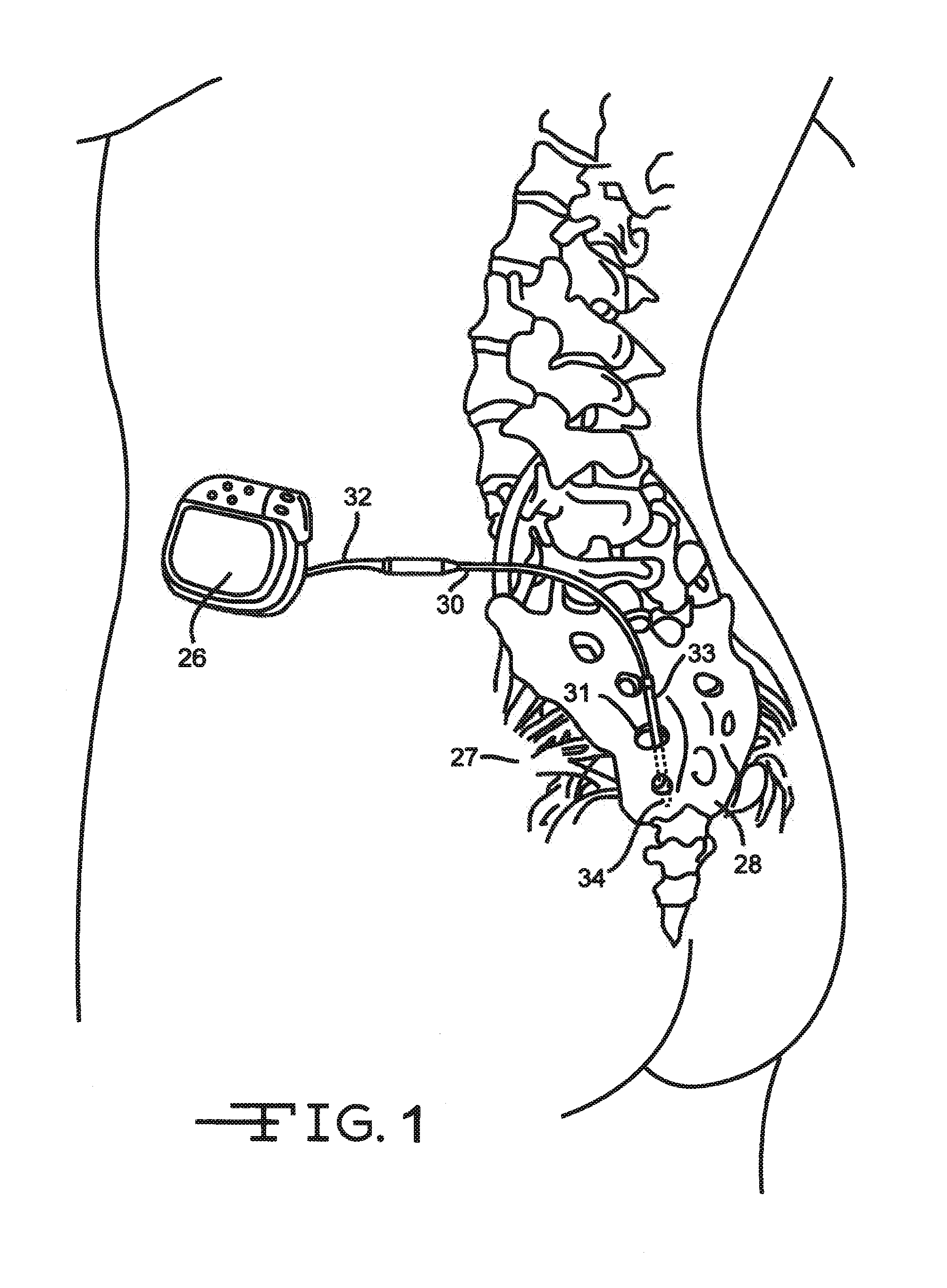 Minimally invasive methods for implanting a sacral stimulation lead