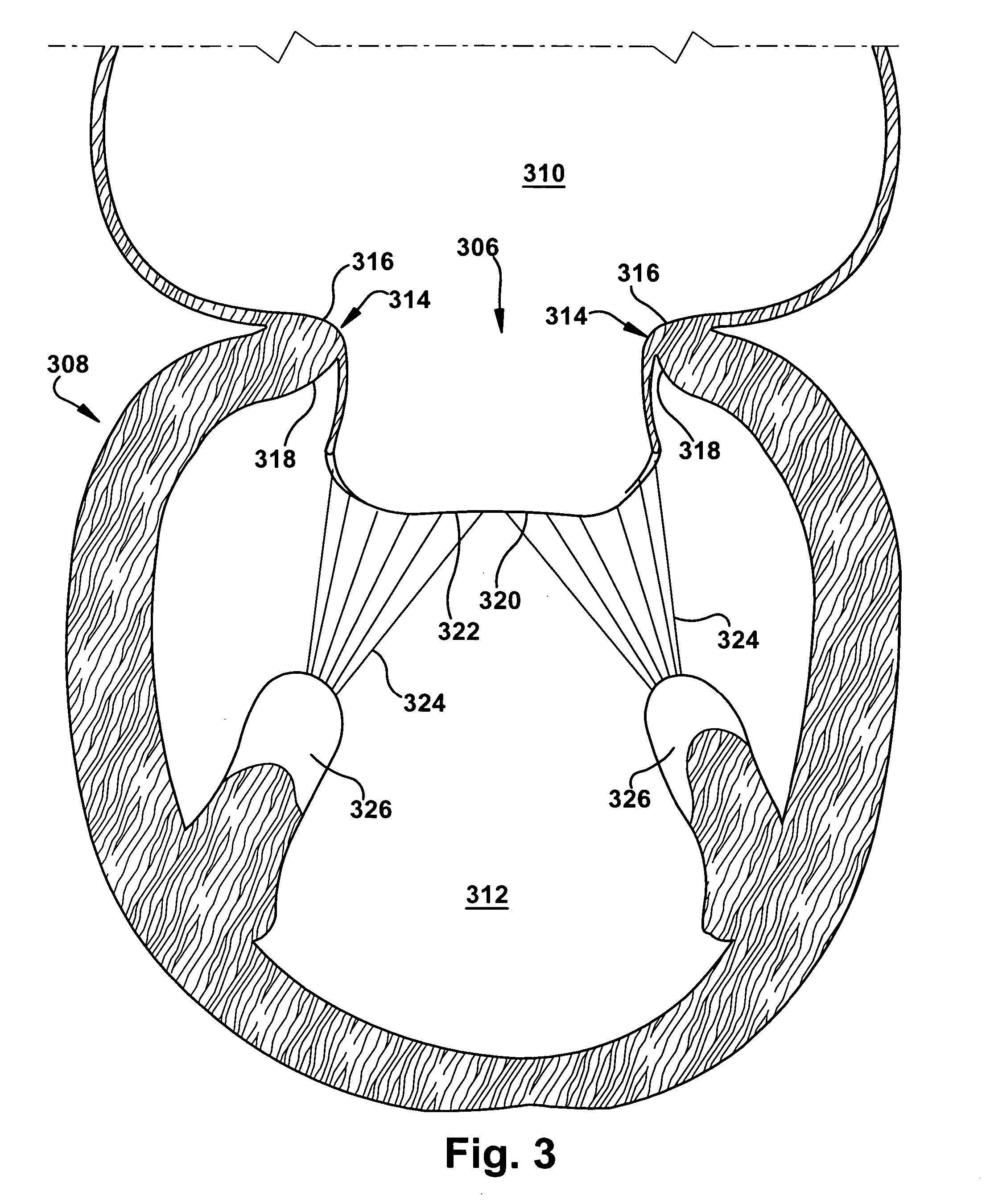 Apparatus and method for replacing a cardiac valve