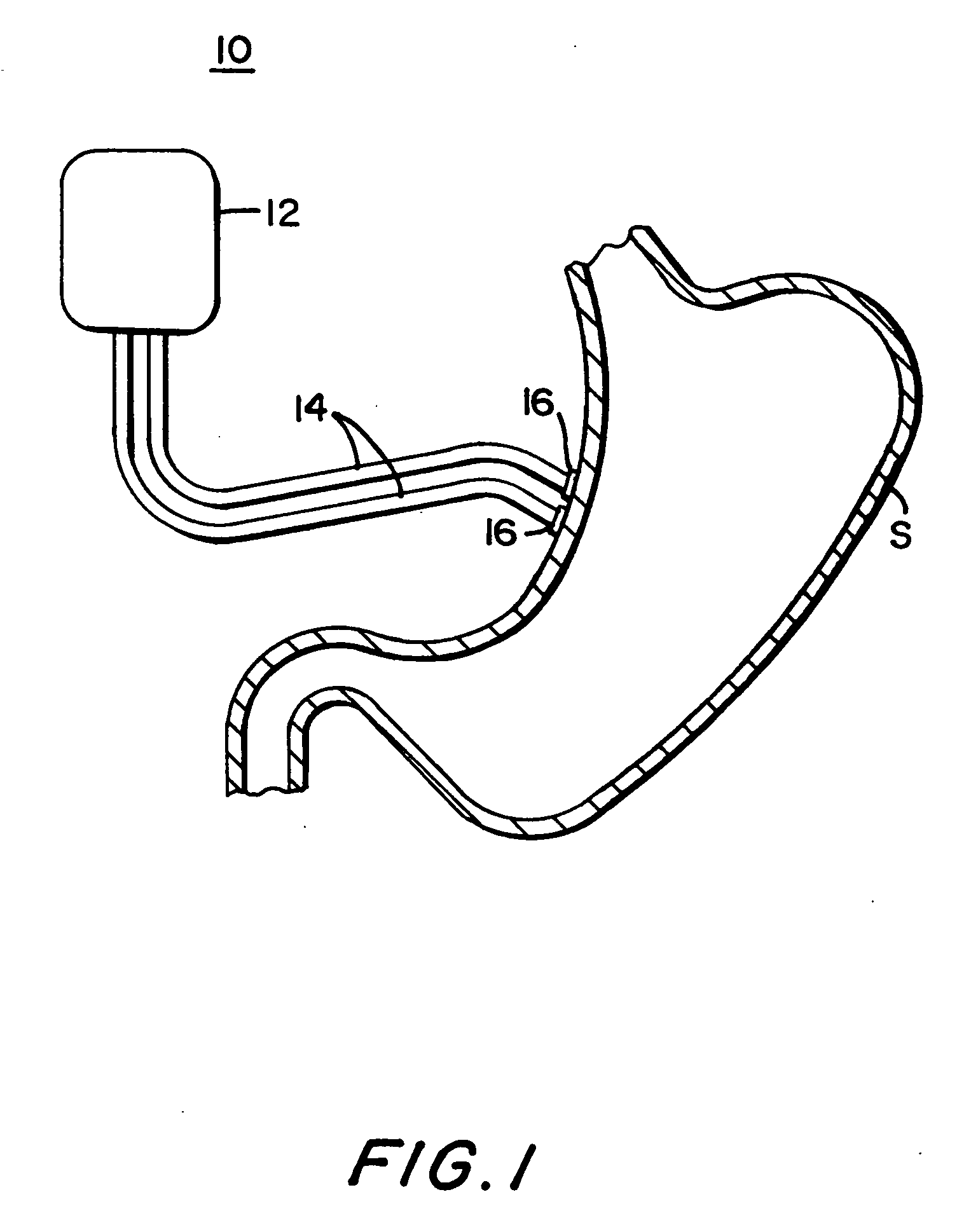 Gastric stimulator apparatus and method for use