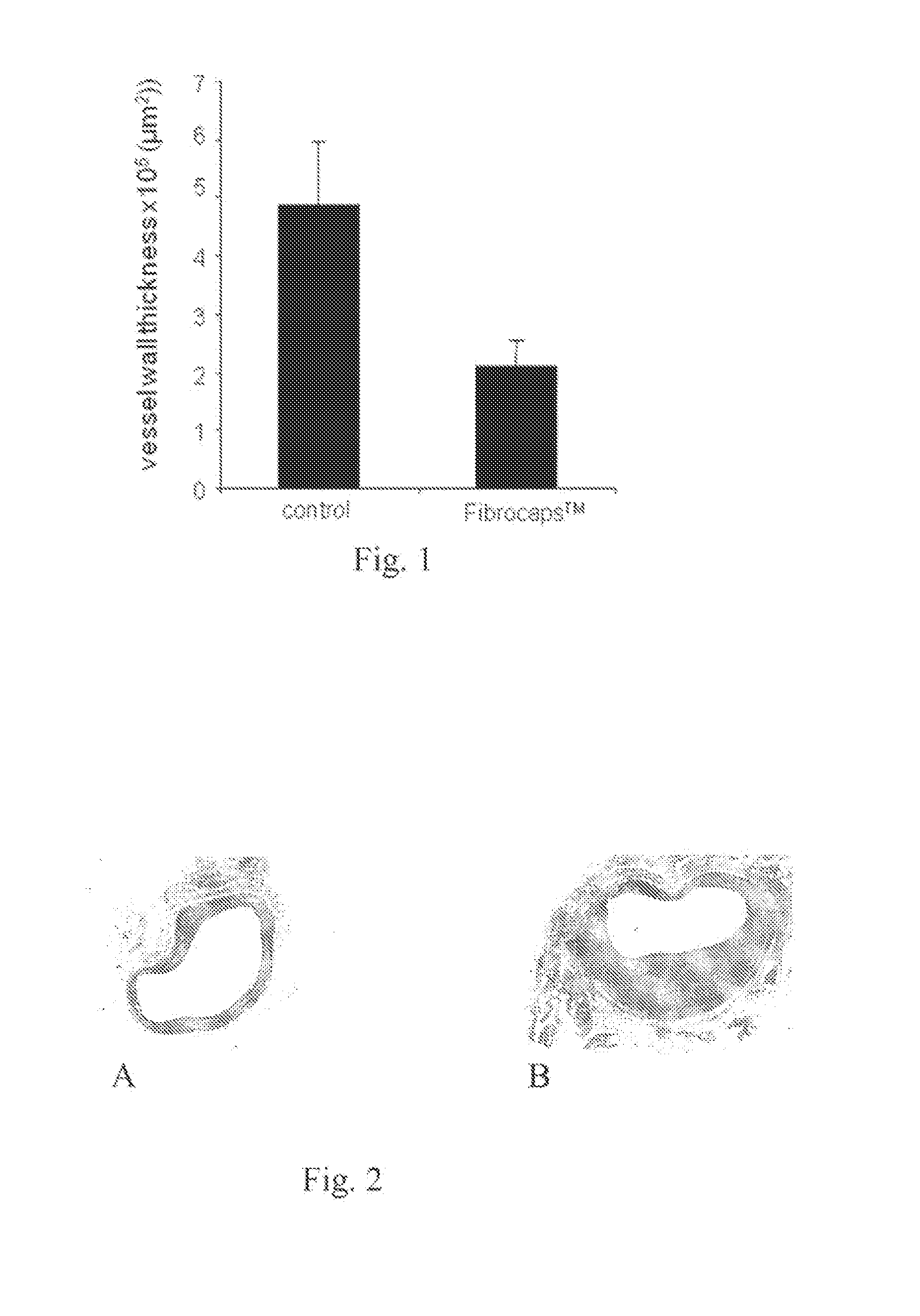 Biodegradable Extravascular Stent