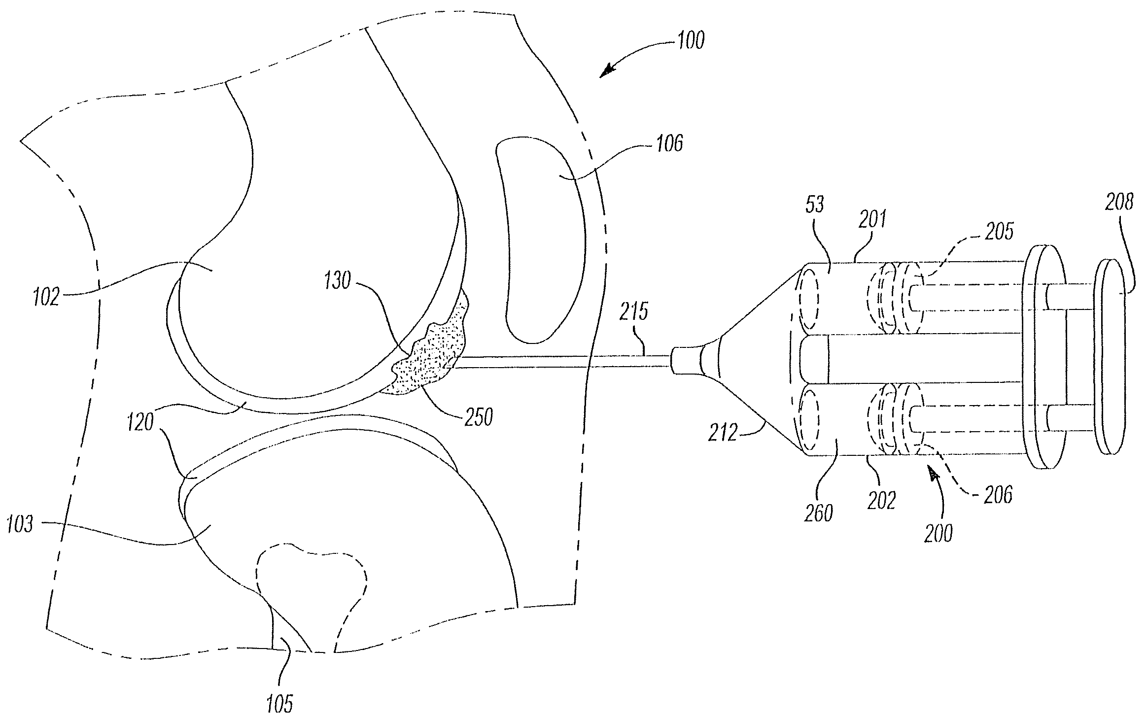 Method and device for repair of cartilage defects