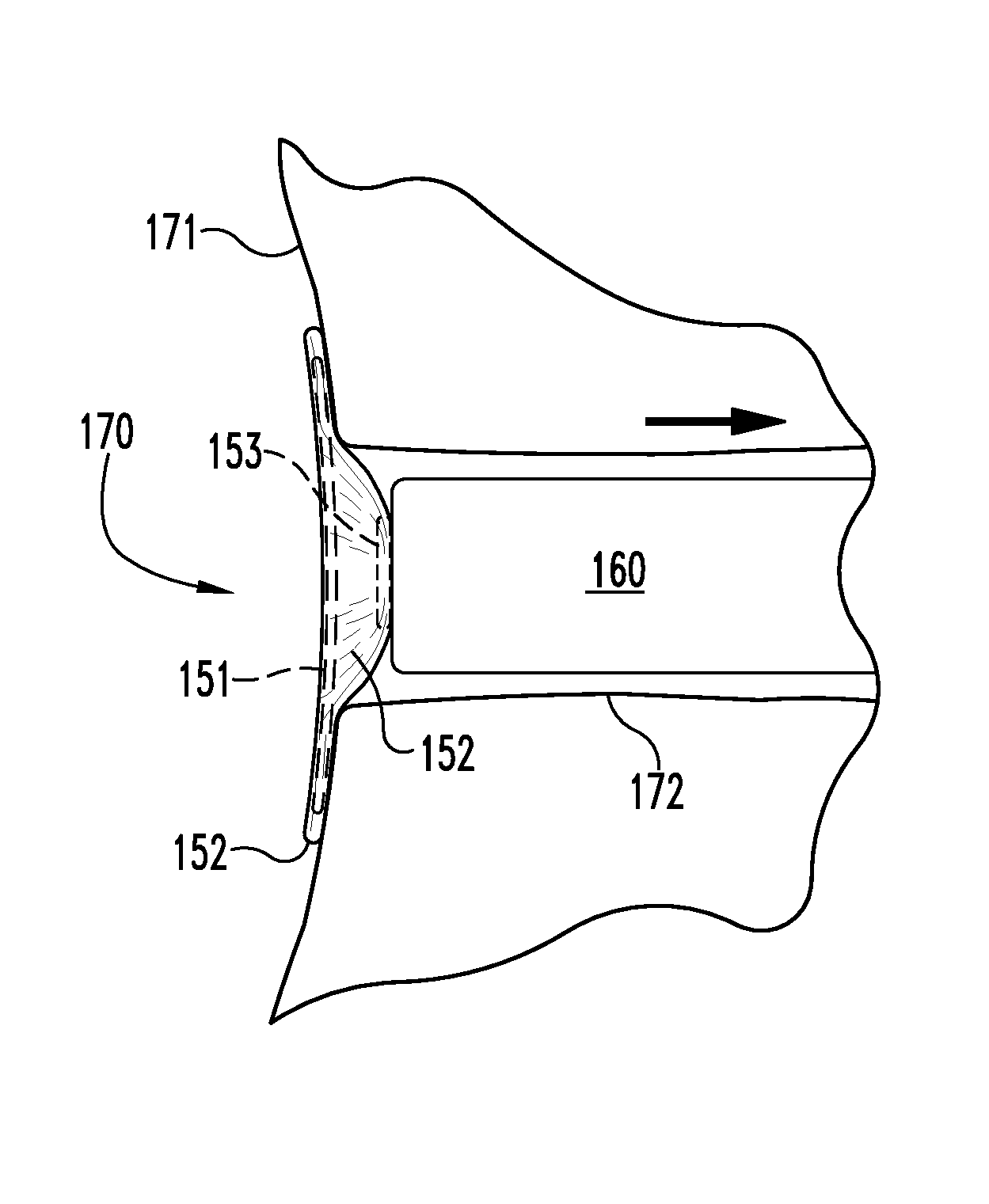 Fistula grafts and related methods and systems useful for treating gastrointestinal and other fistulae