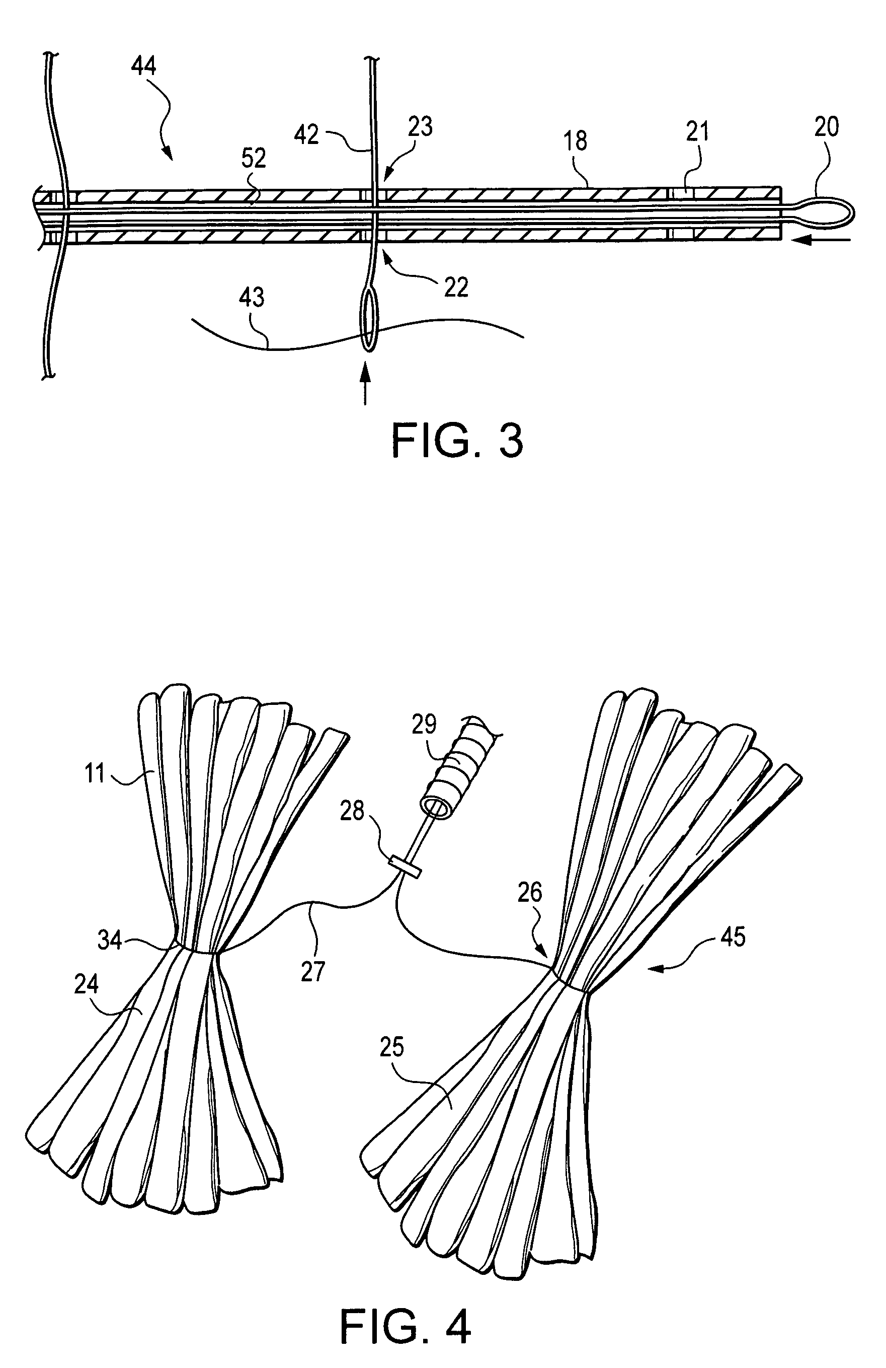 Intragastric device for treating obesity