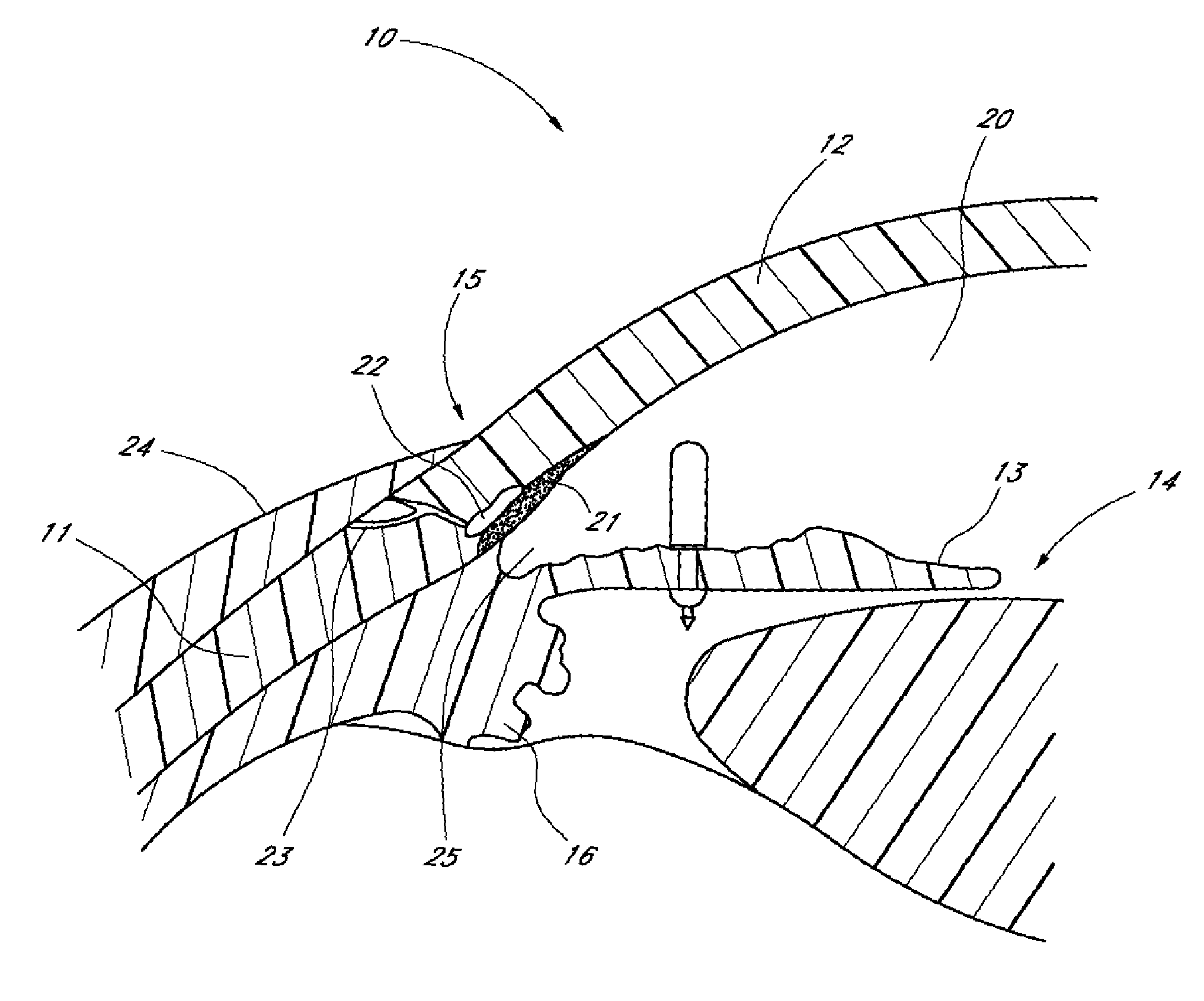 Implants with controlled drug delivery features and methods of using same