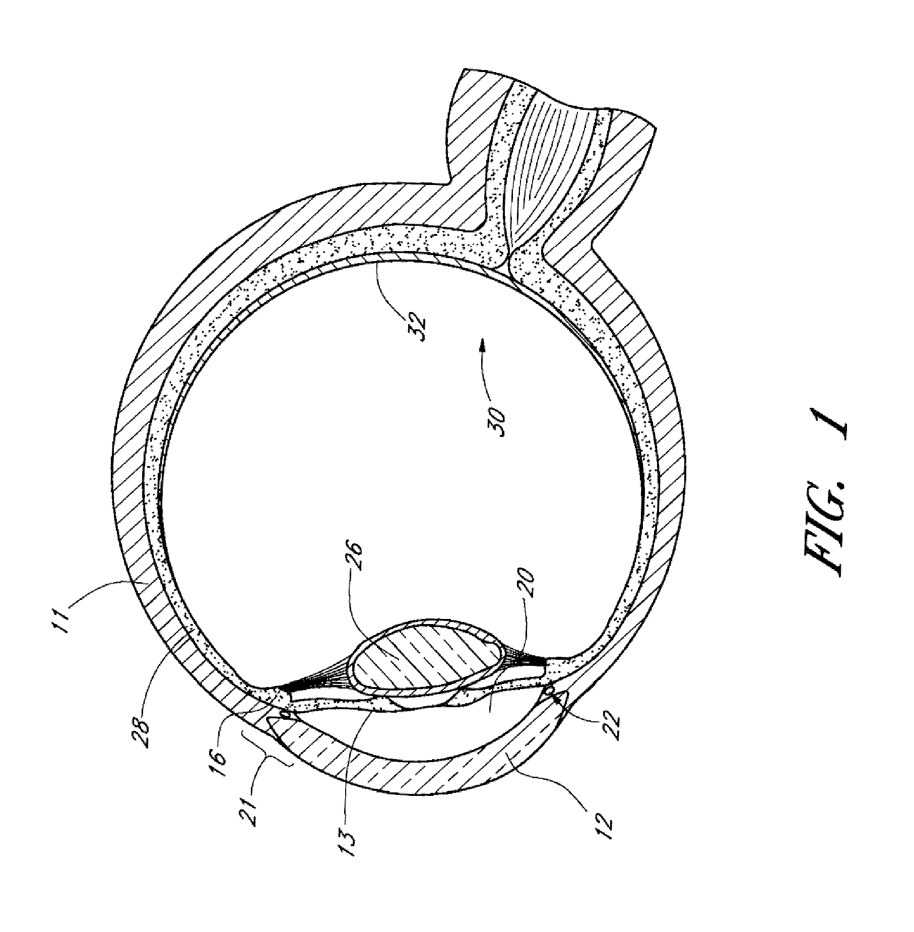 Implants with controlled drug delivery features and methods of using same