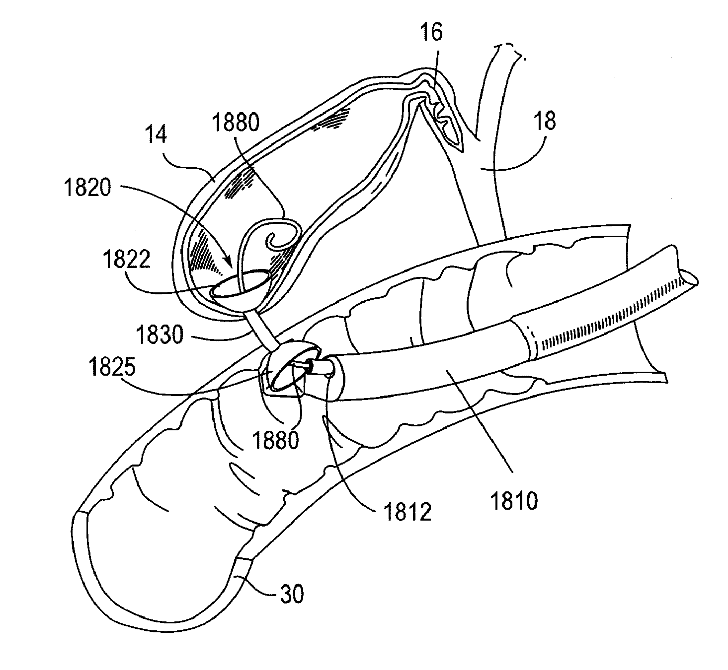 Biliary Shunts, Delivery Systems, Methods of Using the Same and Kits Therefor