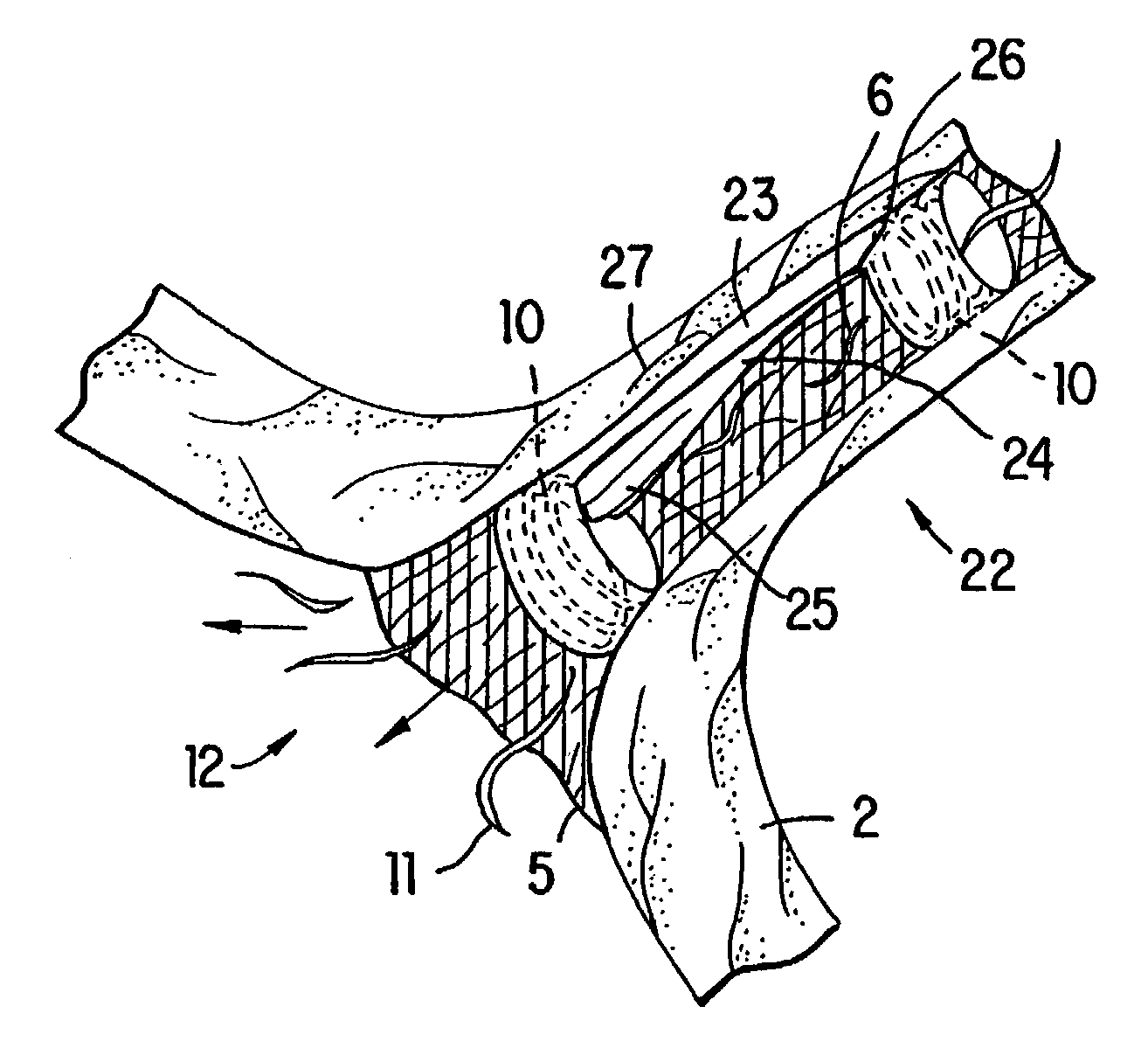 Method and devices for decreasing elevated pulmonary venous pressure