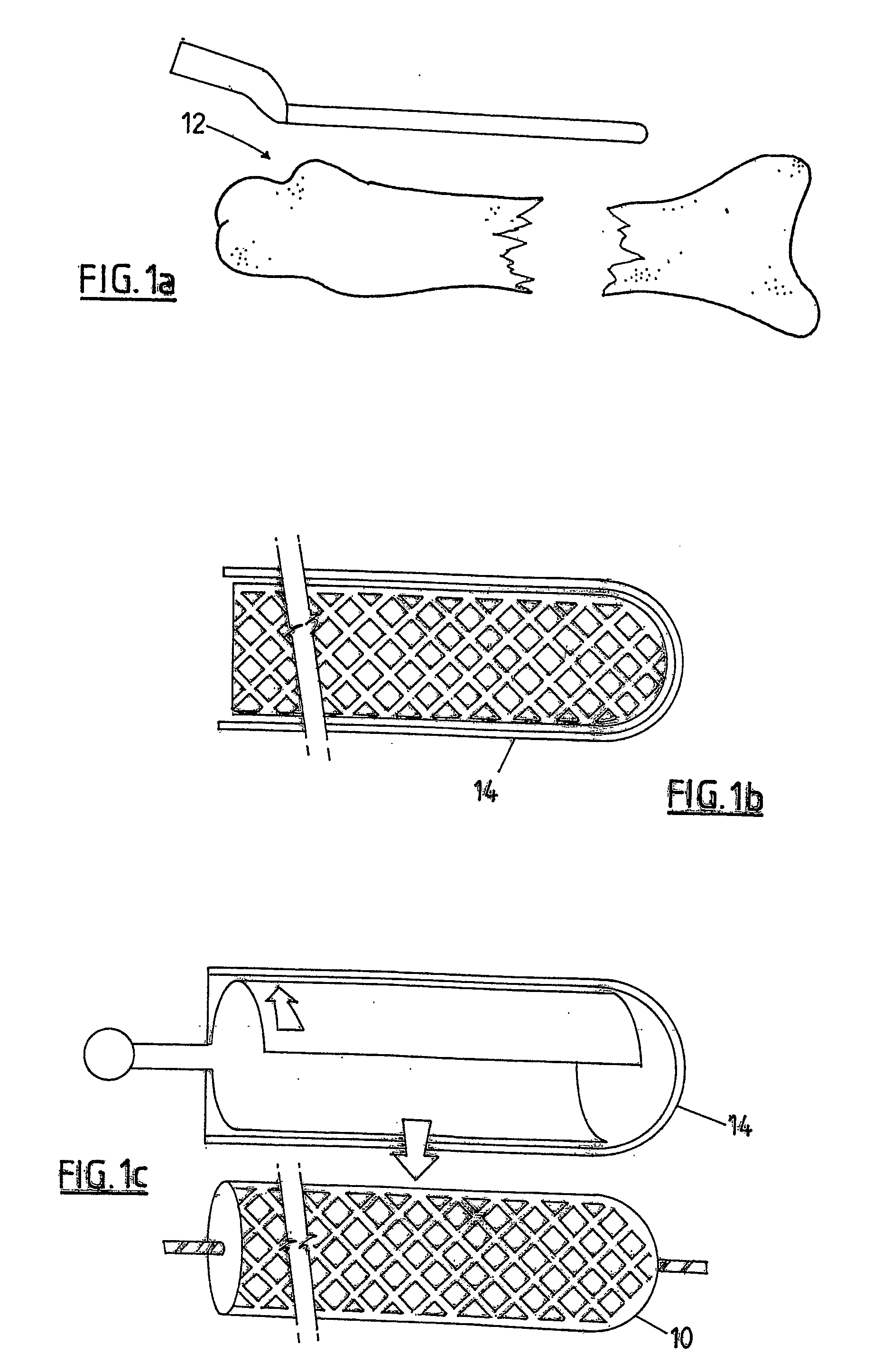 Replacement bone tissue