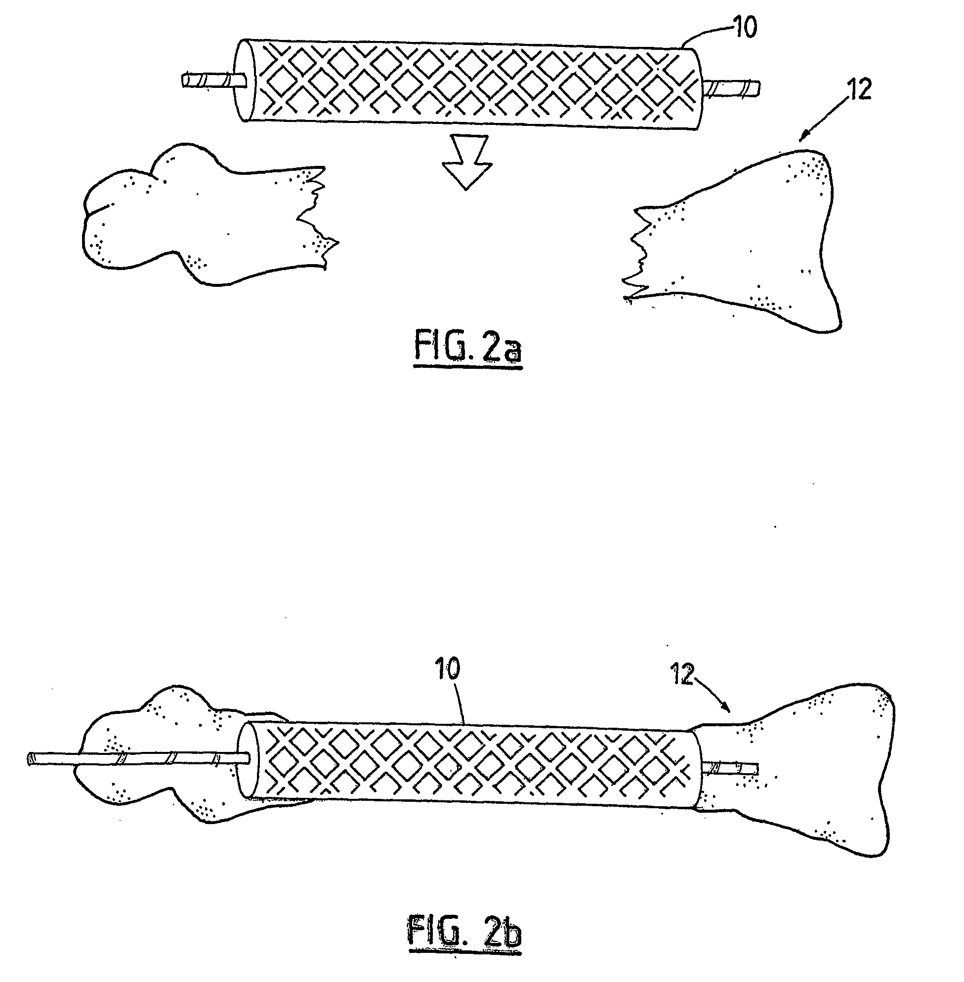 Replacement bone tissue